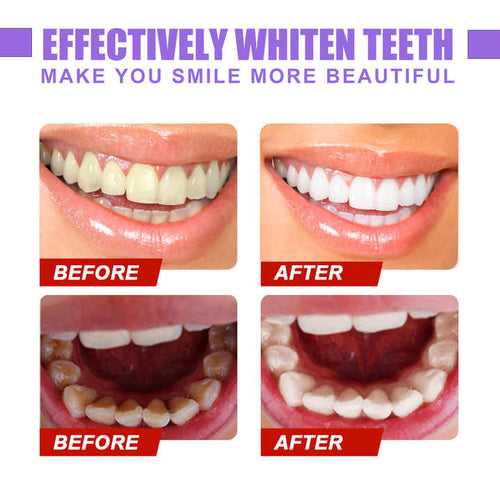 🌟 Glory Smile V34 Correcteur de Couleur – Un Sourire Plus Éclatant en Quelques Secondes